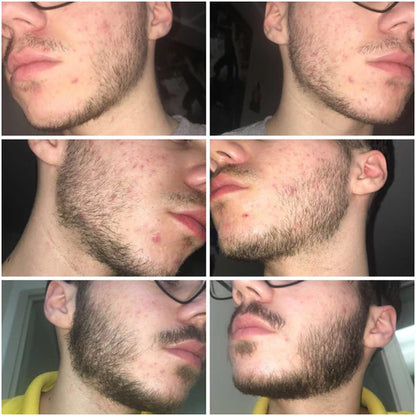 Hair Growth Serum Roll-on Face